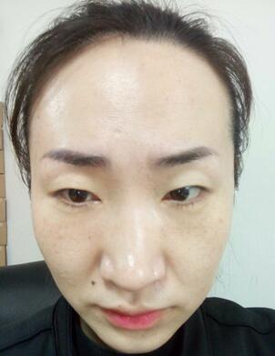 激光祛斑20天后的图片 北京欧华王芳