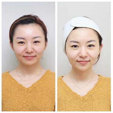 我做射频紧肤经历 医师：北京欧华王芳