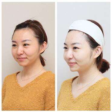 我做射频紧肤经历 医师：北京欧华王芳