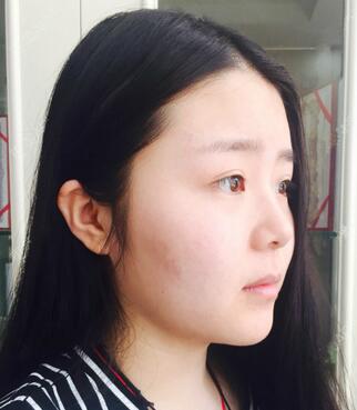 隆鼻整形手术一个月恢复日记