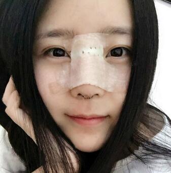 隆鼻整形手术一个月恢复日记
