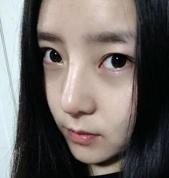 隆鼻整形手术一个月恢复日记