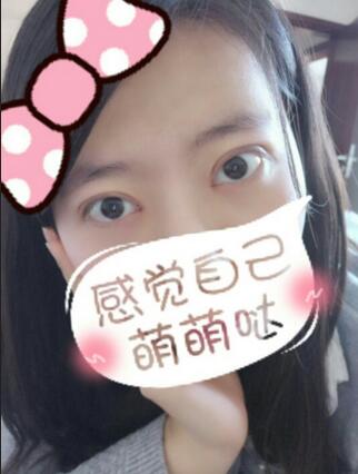 割双眼皮3个月恢复图