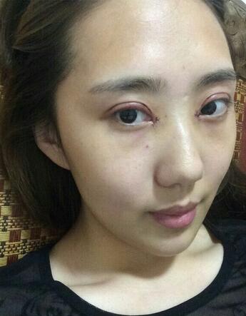 北京金凤凰割双眼皮恢复日记