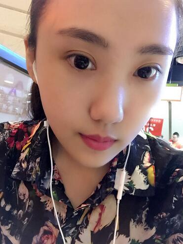 北京金凤凰割双眼皮恢复日记
