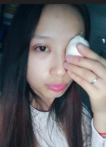 割双眼皮一个月恢复经历图片分享