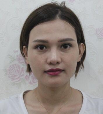 玻尿酸丰太阳7天果图 爱悦丽格丰太阳穴一个月啦~