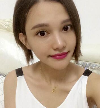 玻尿酸丰太阳7天果图 爱悦丽格丰太阳穴一个月啦~