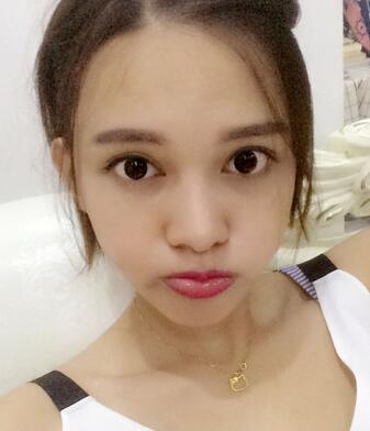 玻尿酸丰太阳7天果图 爱悦丽格丰太阳穴一个月啦~