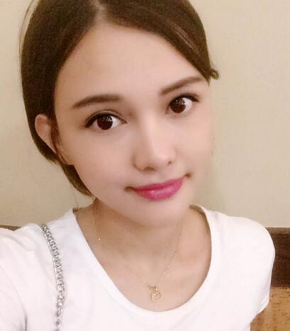 玻尿酸丰太阳7天果图 爱悦丽格丰太阳穴一个月啦~