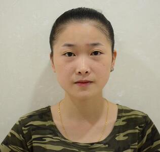 爱悦丽格玻尿酸丰苹果肌、丰下巴、隆鼻