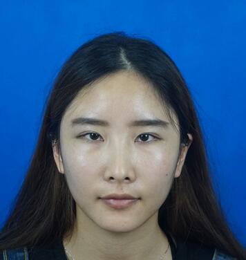 爱悦丽格胶原蛋白丰苹果肌分享