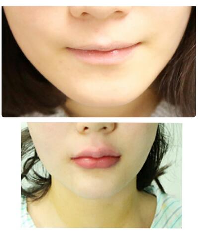 武汉中爱自体脂肪丰唇+面部填充恢复记录