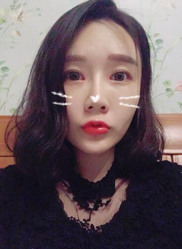 武汉中爱自体脂肪丰唇+面部填充恢复记录