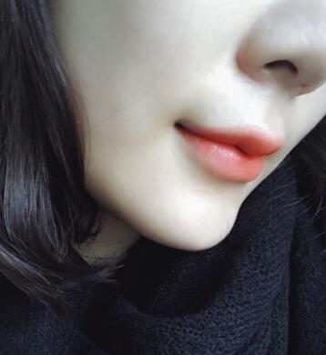 武汉中爱自体脂肪丰唇+面部填充恢复记录