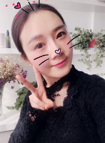 武汉中爱自体脂肪丰唇+面部填充恢复记录