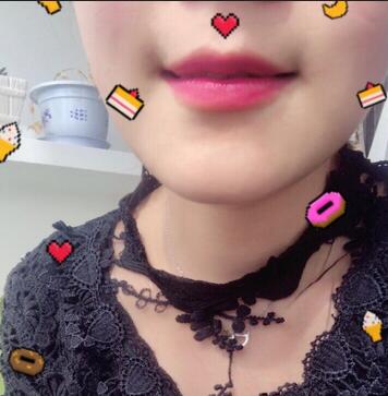 武汉中爱自体脂肪丰唇+面部填充恢复记录