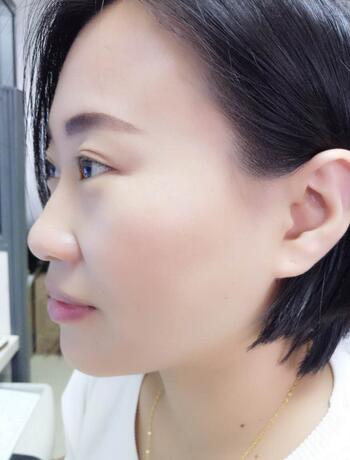 武汉中爱注射瘦脸去鱼尾纹一个月