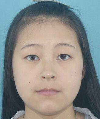 梨花雨割双眼皮恢复半年了