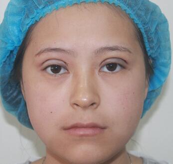 梨花雨割双眼皮恢复半年了