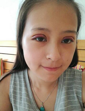 梨花雨割双眼皮恢复半年了