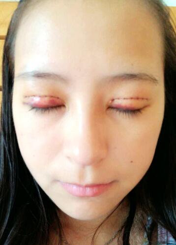 梨花雨割双眼皮恢复半年了