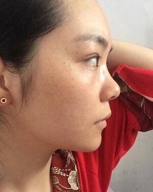 梨花雨隆鼻整形的恢复经历