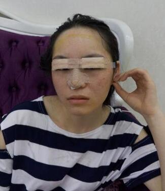 梨花雨隆鼻整形的恢复经历