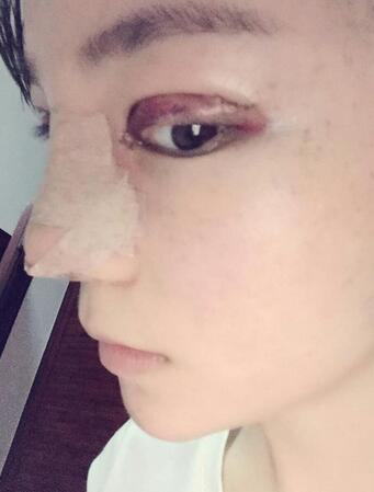 梨花雨隆鼻整形的恢复经历