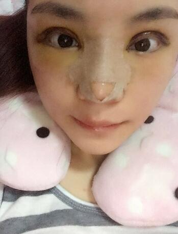 梨花雨隆鼻整形的恢复经历