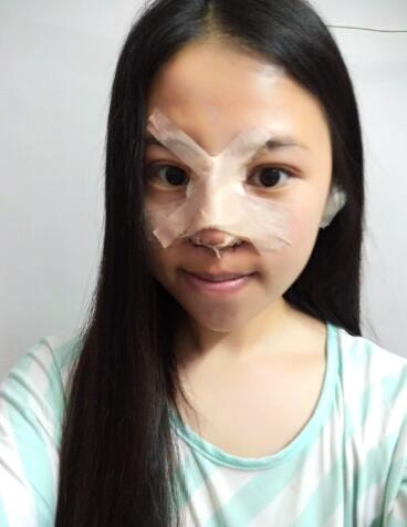 隆鼻整形真实恢复期图片 隆鼻整形一个月了