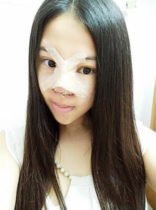 隆鼻整形真实恢复期图片 隆鼻整形一个月了