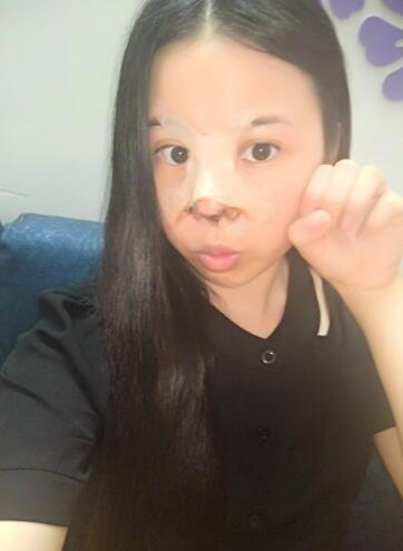 隆鼻整形真实恢复期图片 隆鼻整形一个月了