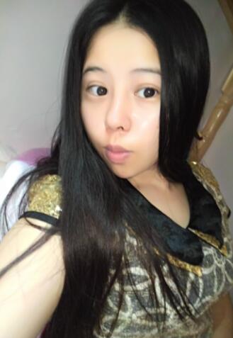 隆鼻整形真实恢复期图片 隆鼻整形一个月了