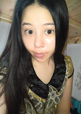 隆鼻整形真实恢复期图片 隆鼻整形一个月了