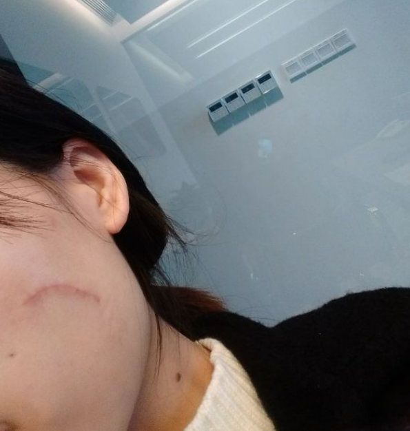 给大家看看我的脸上的手术切除祛疤过程图片