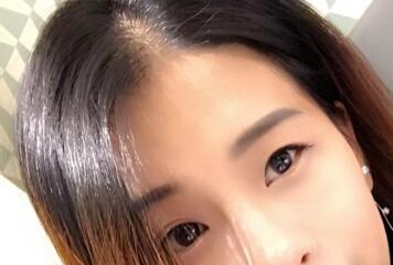 上海韩镜割双眼皮一个月