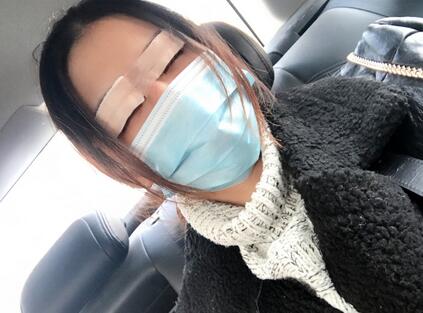 上海韩镜割双眼皮一个月