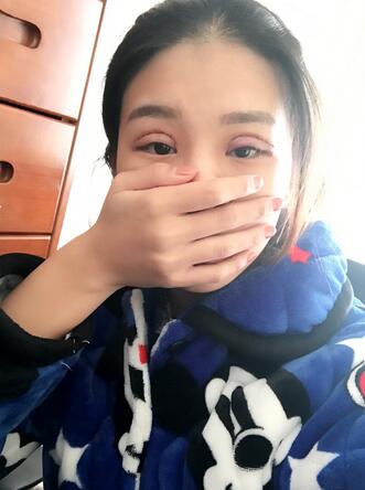 上海韩镜割双眼皮一个月