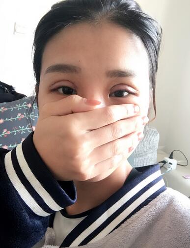 上海韩镜割双眼皮一个月