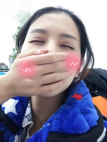 上海韩镜割双眼皮一个月