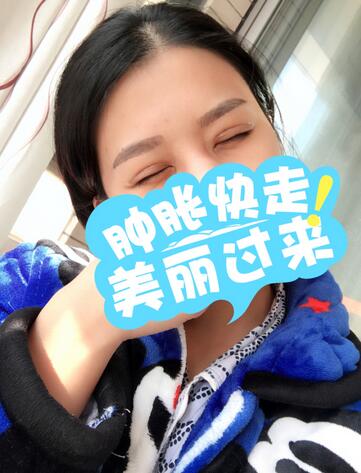 上海韩镜割双眼皮一个月