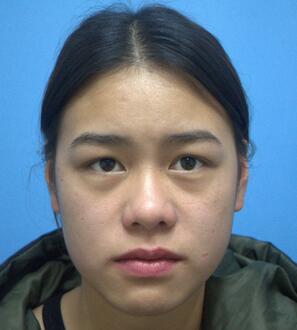 上海韩镜网红套餐半个月经历 双眼皮多项整形+隆鼻整形+脂肪填充