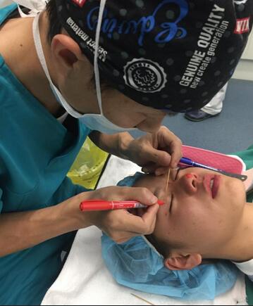 上海韩镜网红套餐半个月经历 双眼皮多项整形+隆鼻整形+脂肪填充