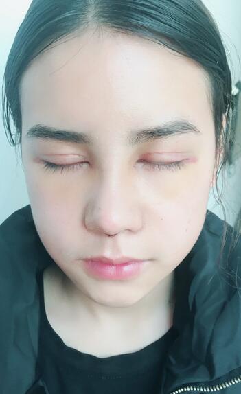 上海韩镜网红套餐半个月经历 双眼皮多项整形+隆鼻整形+脂肪填充