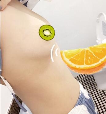 上海韩镜曼托假体隆胸18天