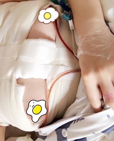 上海韩镜曼托假体隆胸18天