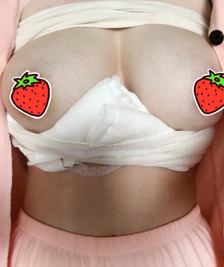 上海韩镜曼托假体隆胸18天