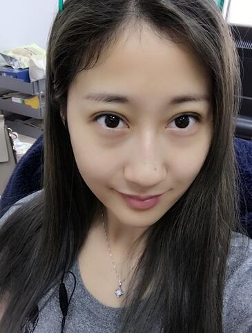 埋线双眼皮七天恢复图