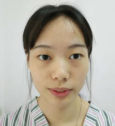 深圳晨曦三点定位双眼皮日记